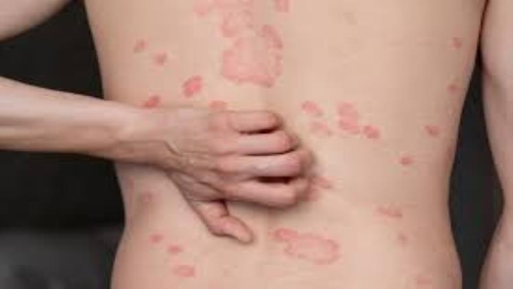How Does Ayurveda Address Painful Skin Rashes and Nerve Issues?